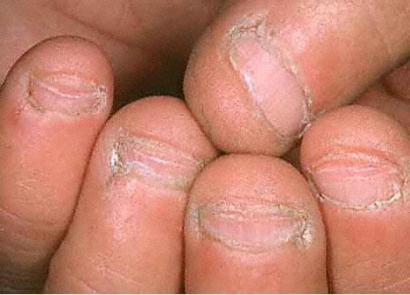 Что будет если грызть ногти на руках Почему нельзя грызть